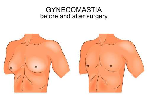 cost of male breast reduction surgery